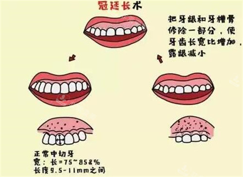 牙冠延长卡通图照片展示
