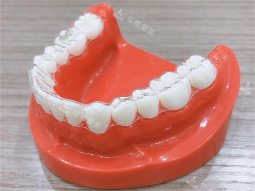 牙齿矫正隐形牙套模型图