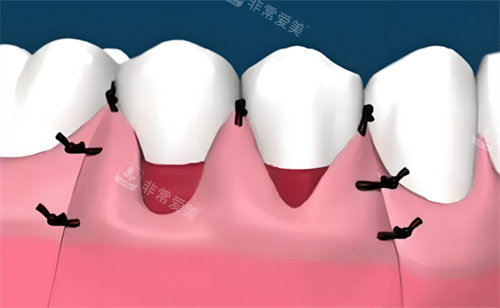 牙龈萎缩治疗