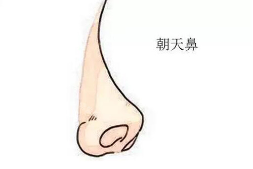 朝天鼻改善卡通图展示 朝天鼻改善卡通图展示