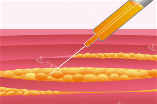 吸脂手术过程原理卡通图 吸脂手术过程原理卡通图