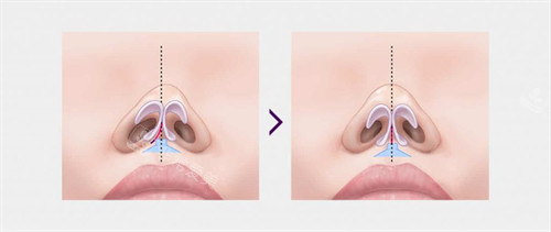 歪鼻和正常鼻子 歪鼻和正常鼻子