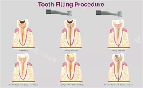 补牙过程图 补牙过程图