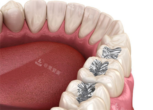 补牙动画展示 补牙动画展示