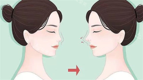 鼻修復(fù)對比 鼻修復(fù)對比