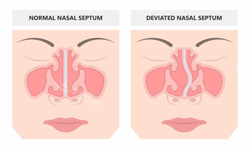 鼻修復(fù)手術(shù)前后對比 鼻修復(fù)手術(shù)前后對比