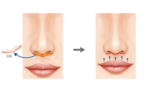 人中缩短手术切除部位