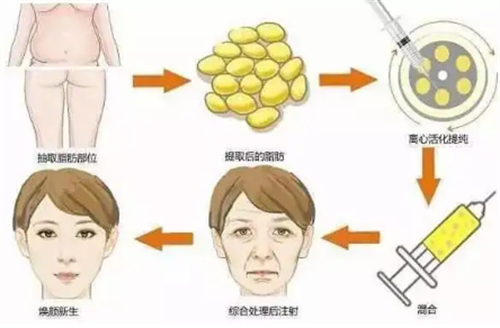 想做脂肪填充又怕结果...