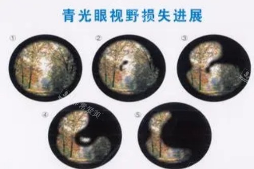 青光眼视野损失进展展示图