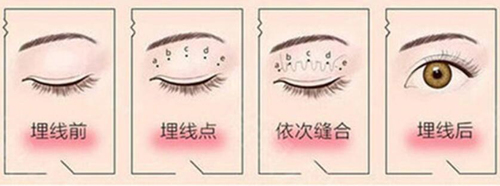 济南做双眼皮好的医生有哪些？张冠勋/徐永/汪帅在当地口碑好！