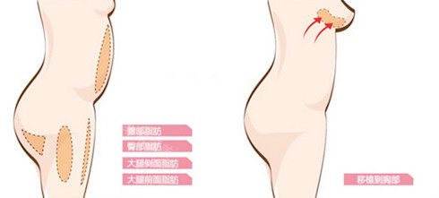 自体脂肪隆胸图 自体脂肪隆胸图