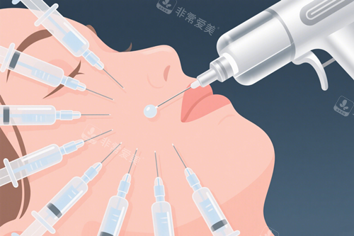 面部注射微整 面部注射微整