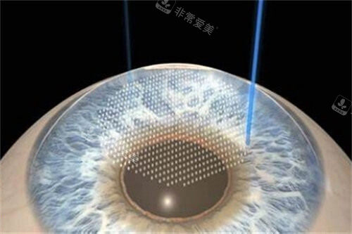 取出全飞秒透镜