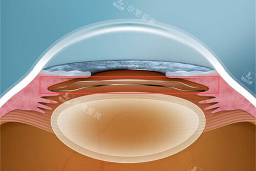 人工晶体植入眼睛的层次