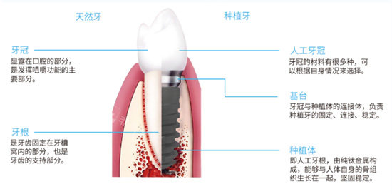 半口种植牙联排牙冠示意图