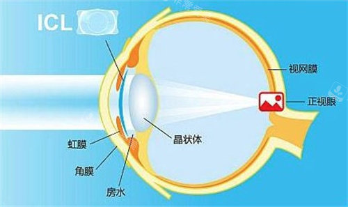 ICL晶体植入手术过程图