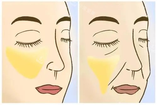 面部脂肪填充示意圖