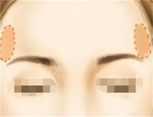 面部脂肪填充豐太陽穴動畫展示圖