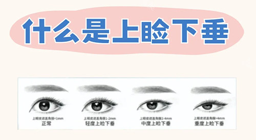什么是上睑下垂 什么是上睑下垂