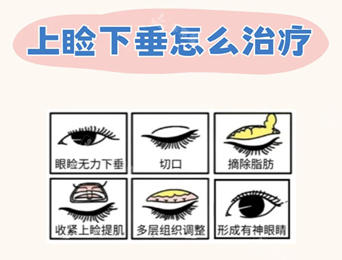 上睑下垂治疗漫画图 上睑下垂治疗漫画图