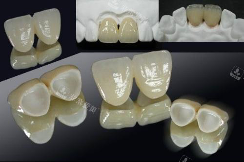 全瓷牙实物展示图