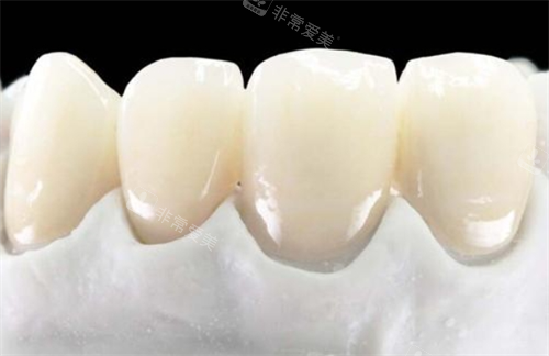 全瓷牙前牙展示