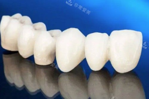 爱尔创全瓷牙模型图