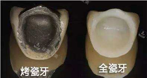 烤瓷牙和全瓷牙展示图