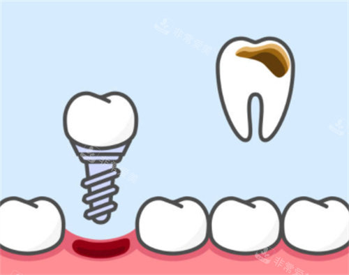 牙齿坏了换种植牙