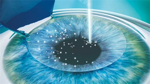 个性化飞秒手术中