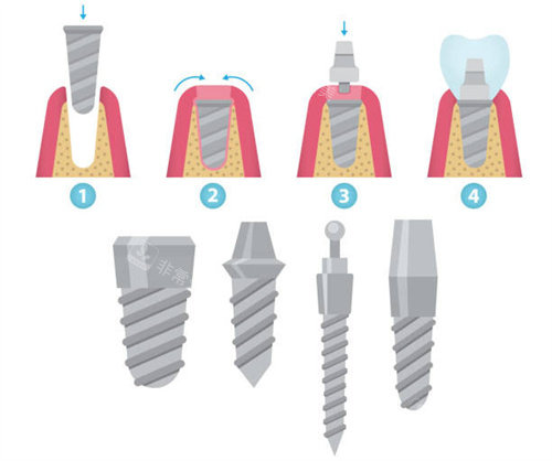 种植牙步骤和植体型号