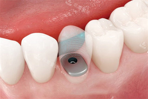 种植牙完成后透视