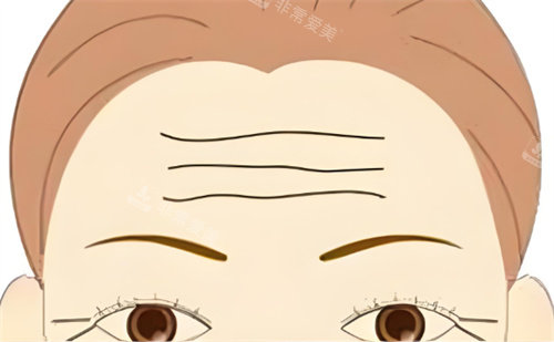 抬头纹