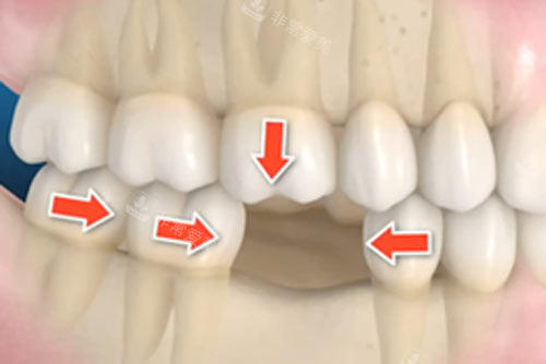 牙齿缺一颗不补的影响图
