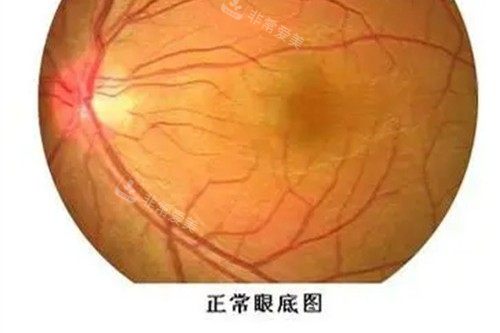 近视眼手术宣传图