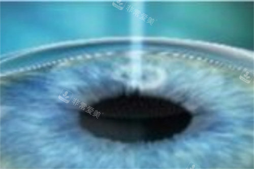 全飞秒制作透镜