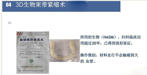 3d生物束带紧缩术材料讲解 3d生物束带紧缩术材料讲解