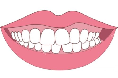 牙齿轻微畸形卡通图片展示
