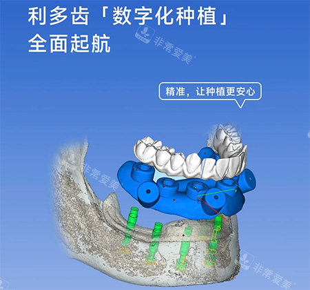 利多齿种植牙怎么样
