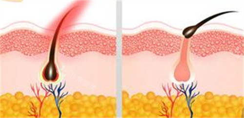 脱毛前后的变化