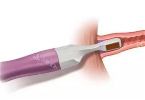 viveve薇蜜私密紧致仪器治疗过程图解