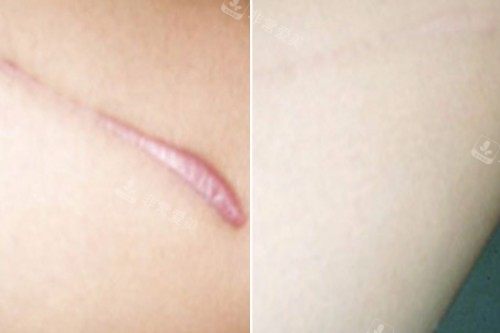 增生疤痕修复对比图