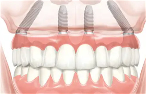 种植牙透视图