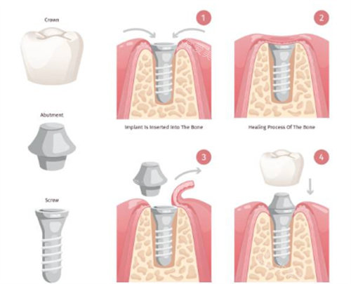 种植牙过程图