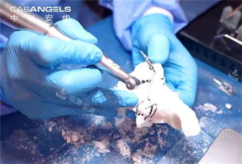 中科安齿种植牙操作过程