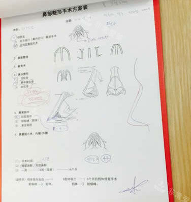 北京柏丽医疗美容医院李劲良做鼻子设计 北京柏丽医疗美容医院李劲良做鼻子设计
