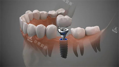 种植牙透视结构图