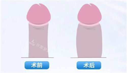 男性私密脂肪填充