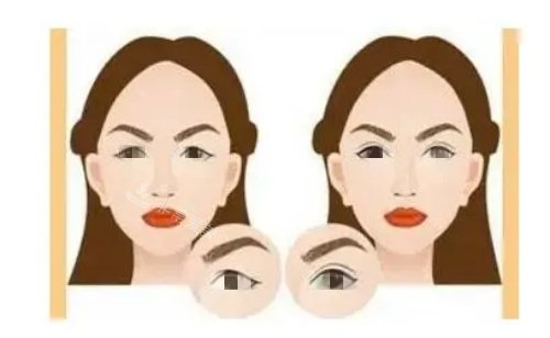 双眼皮术前术后对比图