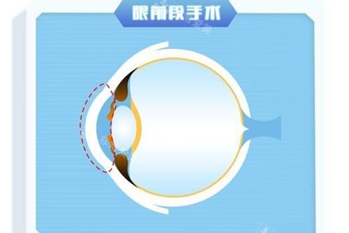 眼前段近视手术示意图